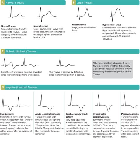 ECG interpretation: Characteristics of the normal ECG (P-wave, QRS ...