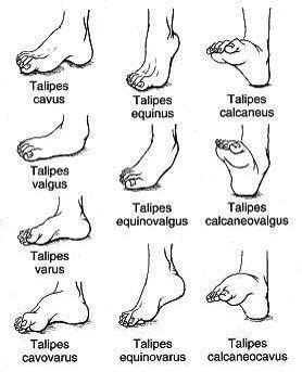 Different forms of tallipes | Pediatric physical therapy, Pediatric nursing, Medical terms