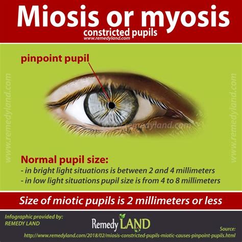 Miosis - constricted pupils (miotic): Causes of pinpoint pupils - Remedy Land