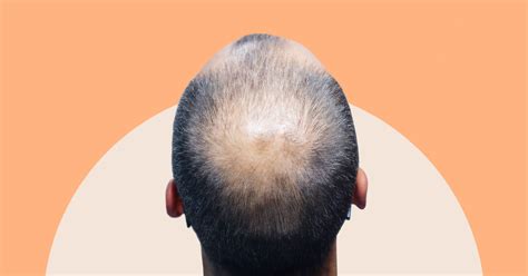 Androgenic Alopecia: Causes, Stages, & Treatments | AndSons SG