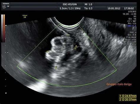 Endometriosis images and severity - gynsurgery.org