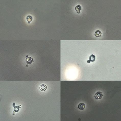 Dysmorphic erythrocytes in a patient with membranous glomerulonephritis. #urinarysediment #urine ...