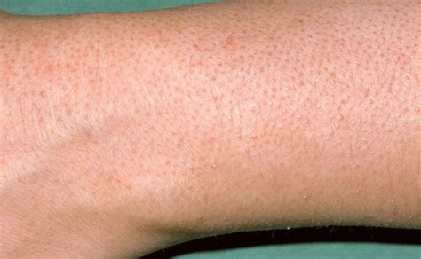 Keratosis Pilaris or Bumpy Skin on Arms Treatment - Skincarederm