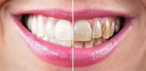 Teeth Whitening Special - 209 NYC Dental: Cosmetic Dentists