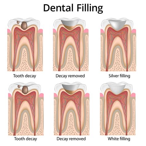 Cavity Filling vs. Root Canal - Two Main Difference - Dental Pickup