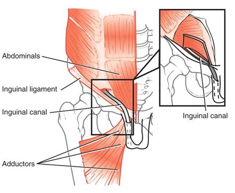 ATHLETIC PUBALGIA SPORTS HERNIA PDF