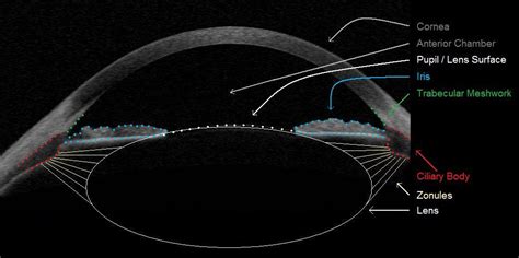 Glaucoma Modesto / Stockton - Anatomically Narrow Angles - Dr. Ash