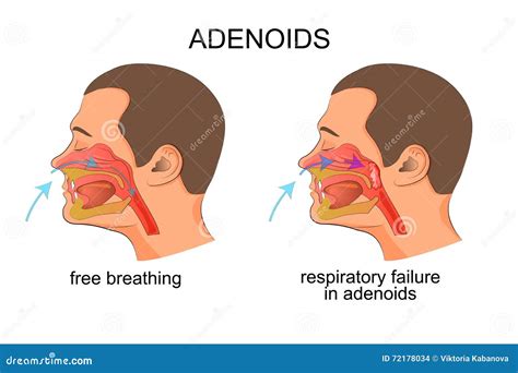 Enlarged Adenoid Glands Cartoon Vector | CartoonDealer.com #46045793