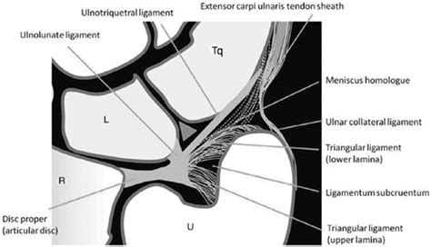 Radioulnar Ligament Wrist Mri Radiology