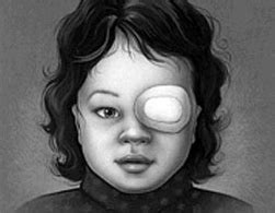 Amblyopia - American Association for Pediatric Ophthalmology and Strabismus