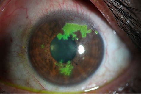 Herpes Keratitis: Causes, Symptoms, and Treatment - The Eye News