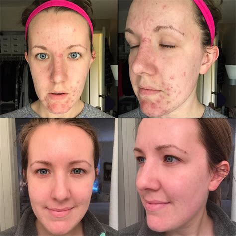 [before & after] starting 2019 with clear skin, finally! : r/SkincareAddiction