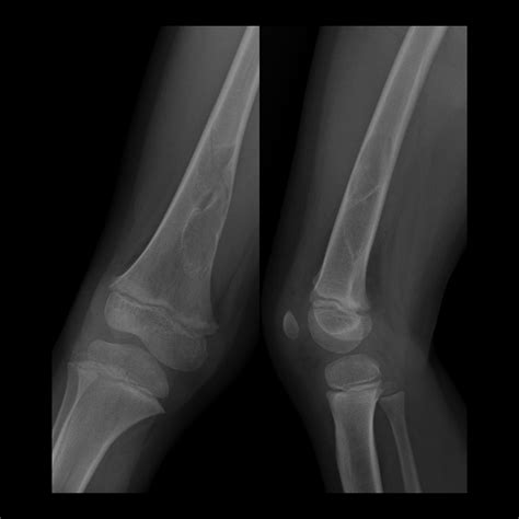 Pediatric Pathologic Fracture | Pediatric Radiology Reference Article ...