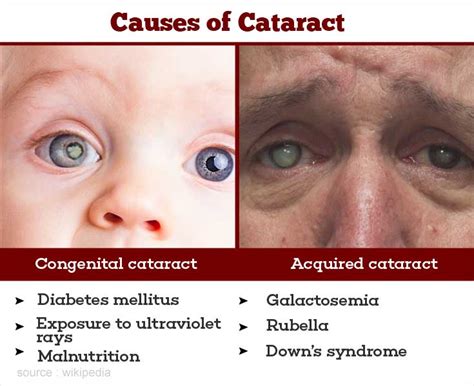 Cataract - Causes, Symptoms, Diagnosis, Treatment & Prevention