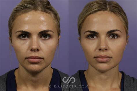 Cheek Fillers Before and After Photo Gallery | Marina del Rey, CA | Stoker Plastic Surgery