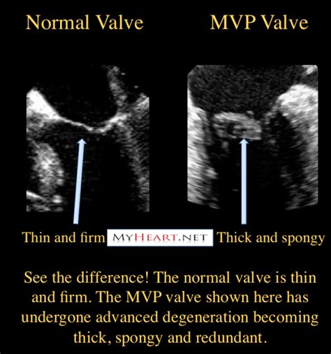 Understanding Mitral Valve Prolapse