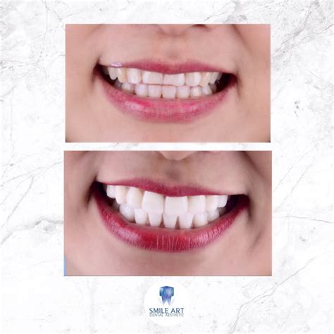 Instant Veneer - Smile Art Dental Aesthetic