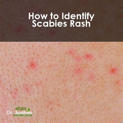 How To Identify Scabies Rash – BIAYAKU