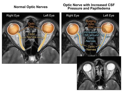 Normal Optic Nerve Mri