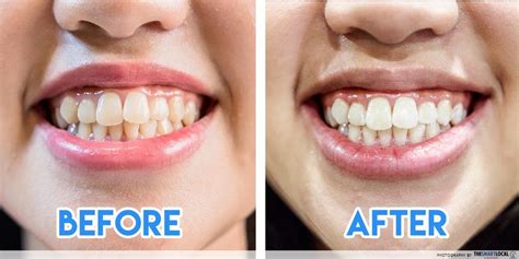 Pin on Teeth Whitening Before And After