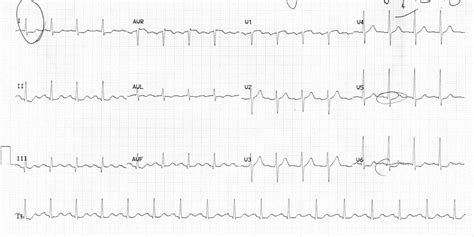 Myocardial Ischaemia • LITFL • ECG Library Diagnosis