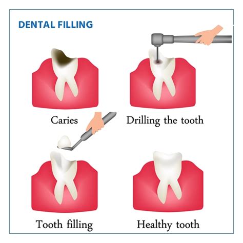 Dental Cavity Filling