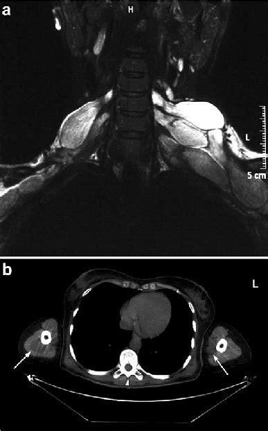 a. Brachial plexus MRI, coronal section (T2-weighted). Multiple... | Download Scientific Diagram