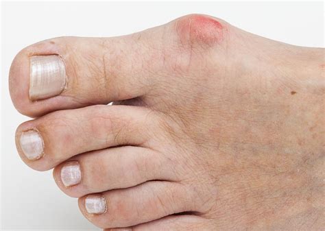 What are the Most Common Causes of Toe Pain? (with pictures)