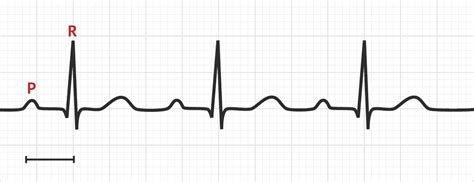 The PR Interval | ECG Basics - MedSchool