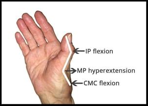 Treating CMC Joint Arthritis - Collapse Deformities of the Thumb