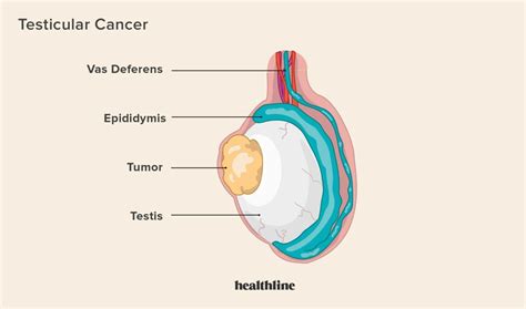 Testicular Cancer: Risk Factors, Symptoms, and Diagnosis