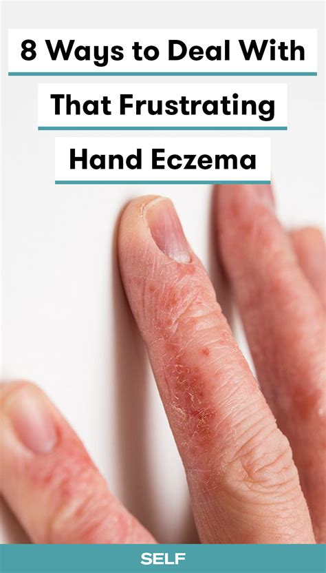 How to finally get relief for your hand eczema – Artofit