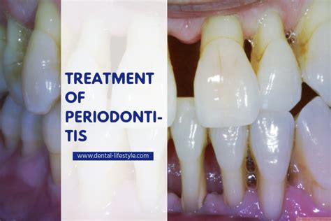 periodontitis-treatment - Dental Lifestyle