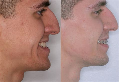 Corrective Jaw Surgery | Orthognathic Surgery | Misaligned Jaws