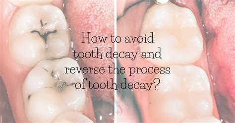 How to avoid tooth decay and reverse the process of tooth decay? - Expert Dental Care