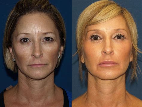 Liquid Facelift San Diego | Facial Filler Facelift San Diego