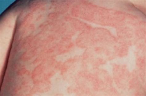 Skin Fungal Rash