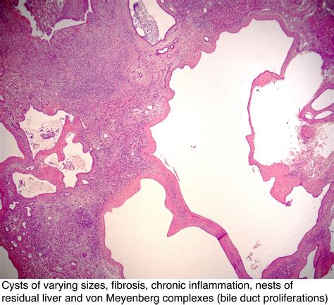 Hepatic Lipidosis Histology