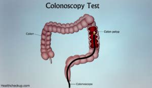 What is a Colonoscopy Test? Procedure & Alternatives to Colonoscopy