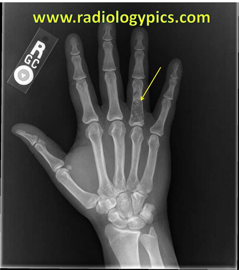 Enchondroma – Phalanx | RADIOLOGYPICS.COM