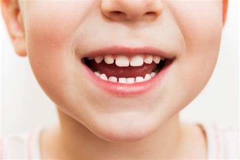 Do Cavities in Baby Teeth Need Fillings? - Clover Kids Dental