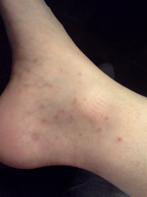 I have spots on my legs, ankles, feet, and arms that itch really