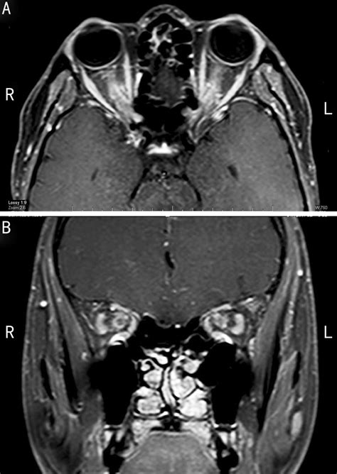 Contrast-enhanced MRI showing marked enhancement of the optic nerve... | Download Scientific Diagram