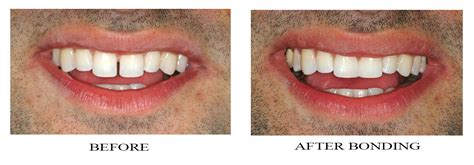 Veneers Create A Beautiful Smile! - Barbag dental. Creating beautiful ...