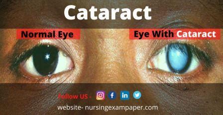 cataract image - Nursing Exam Paper