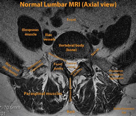 Healthcare Extreme How To Read An MRI Lumbar Spine In 8 Easy Steps