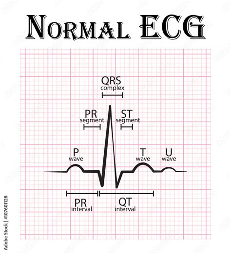 Normal ECG ( Electrocardiogram ) ( P wave , PR segment , PR interval , QRS complex , QT interval ...