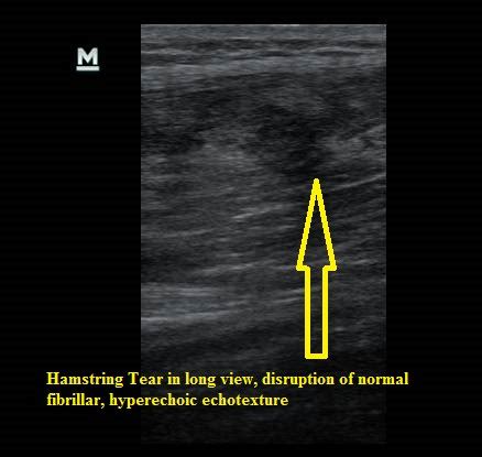 Hip Ultrasound