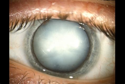 Hypermature Cataract - Retina Image Bank