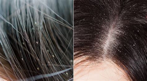 Head Lice vs. Dandruff: Identifying What You Have